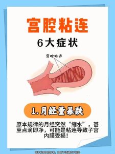 宫腔粘连会复发吗-两性知识丨两性健康--你想了解的我都知道