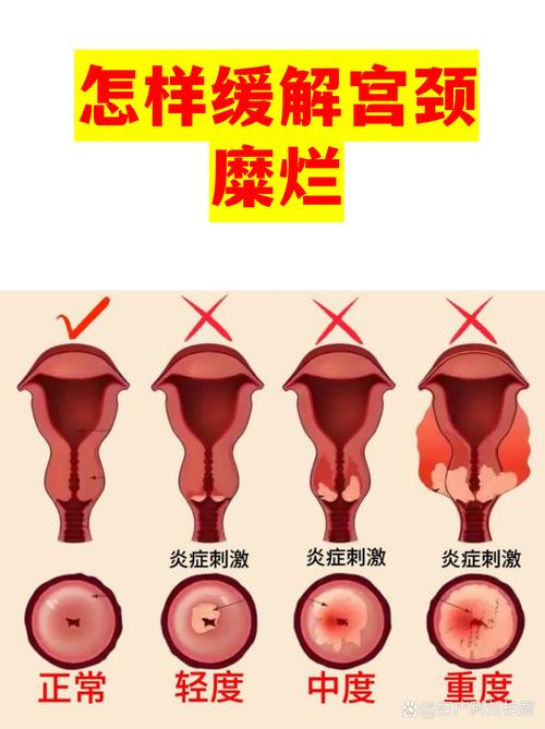 宫颈糜烂需要治疗吗