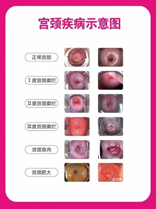 宫颈糜烂需要治疗吗