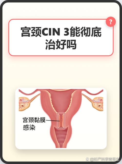 宫颈病变治疗后要避孕吗