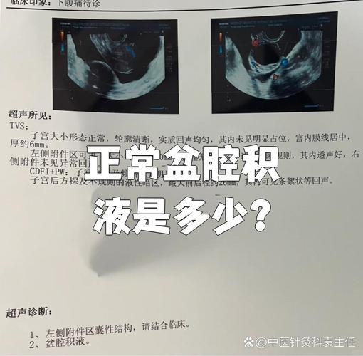 生理性盆腔积液的量级是多少
