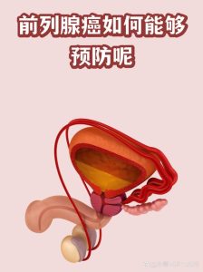 前列腺癌能预防吗？医生告诉你真相和实用方法-两性知识丨两性健康--你想了解的我都知道