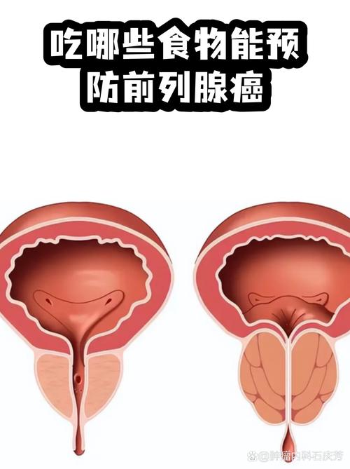 前列腺癌能预防吗