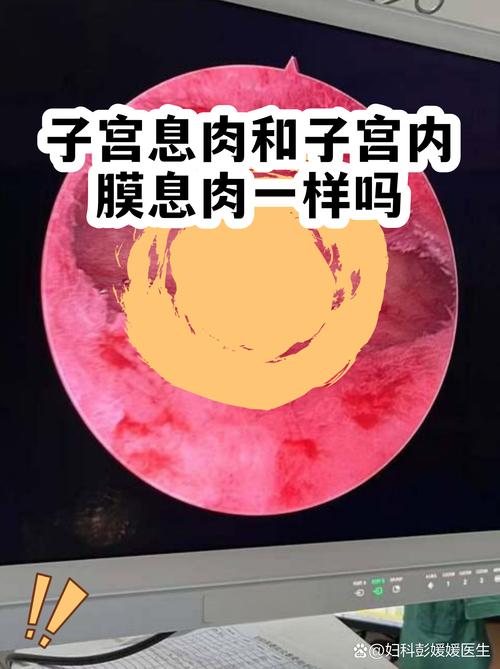 性欲低和子宫内膜息肉有关吗