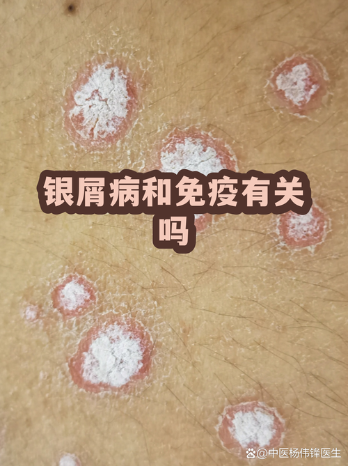 性欲低和银屑病有关吗