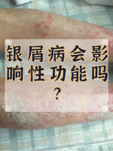 性欲低和银屑病有关吗?一文讲清两者关系-两性知识丨两性健康--你想了解的我都知道