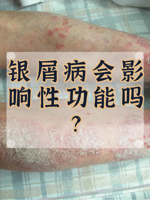 性欲低和银屑病有关吗
