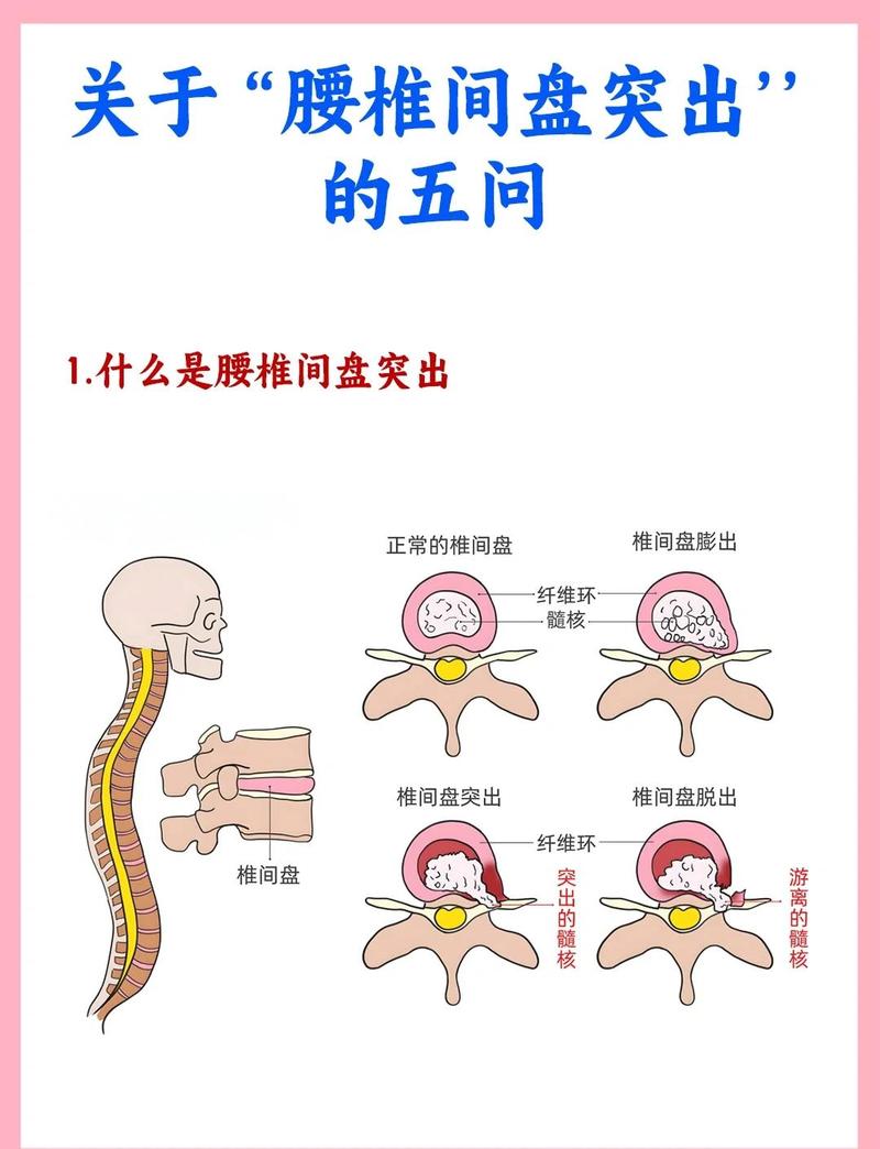 性欲低和腰椎间盘突出有关吗