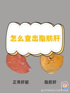 性欲低和脂肪肝有关吗-两性知识丨两性健康--你想了解的我都知道