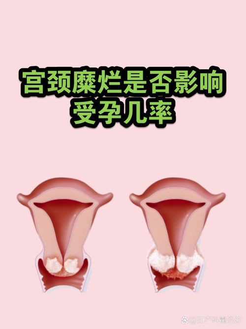 宫颈手术会不会影响受孕-相关配图
