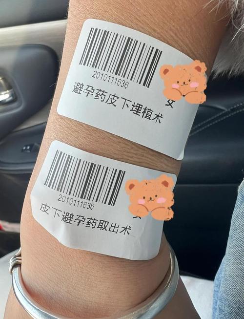 皮下埋植到期取出麻烦吗