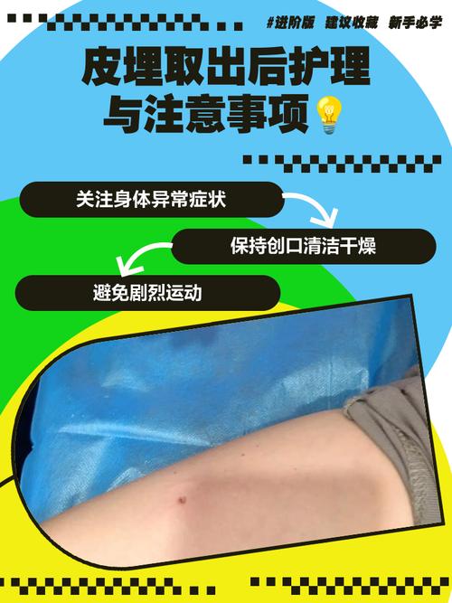 皮下埋植到期取出麻烦吗