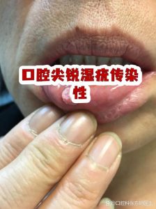 口腔接触会传播哪些性传播感染?-两性知识丨两性健康--你想了解的我都知道