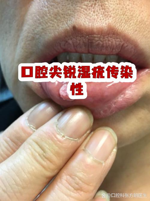 口腔接触会传播哪些性传播感染
