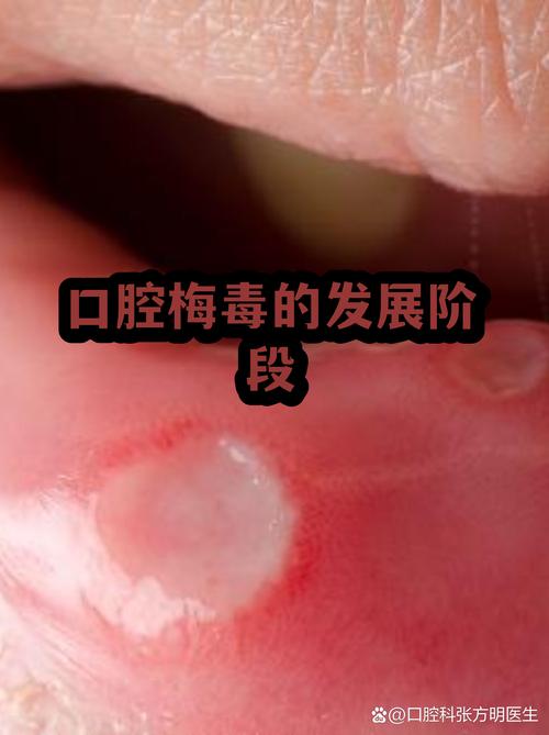 口腔接触会传播哪些性传播感染