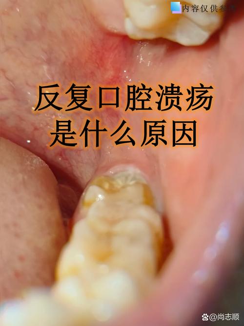 性欲低和口腔溃疡反复有关吗