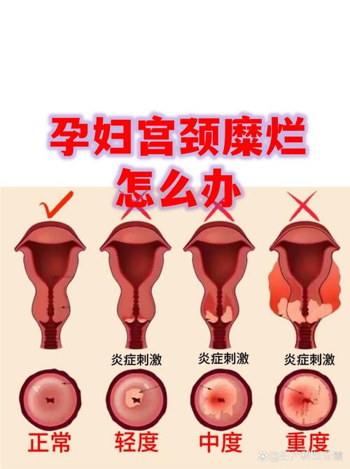 怀孕期间查出宫颈病变怎么处理