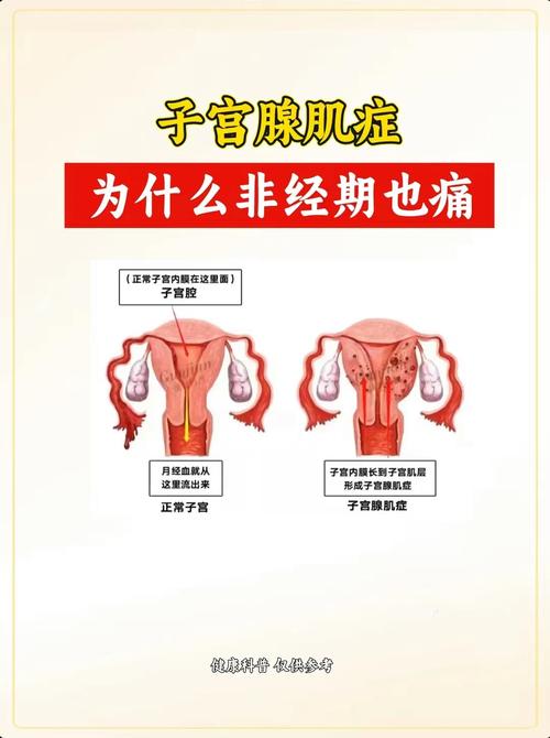 性欲低和子宫腺肌症有关吗