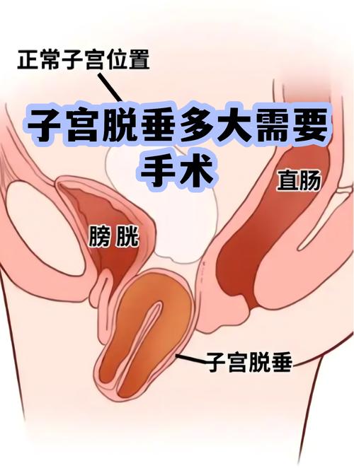 老年女性子宫脱垂要手术吗