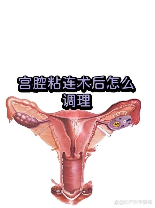 宫腔粘连术后该怎么养内膜-相关配图
