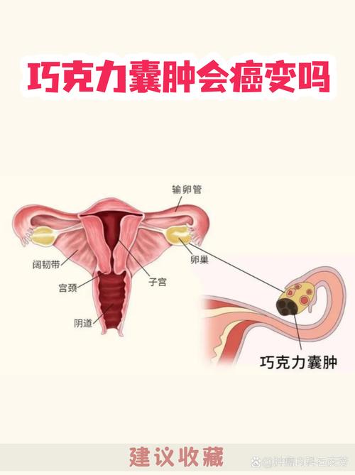 巧克力囊肿和卵巢癌有关吗