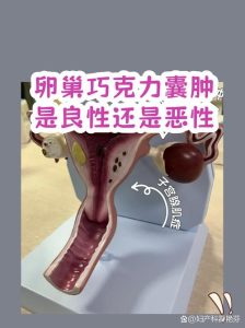 巧克力囊肿会不会变成卵巢癌?-两性知识丨两性健康--你想了解的我都知道