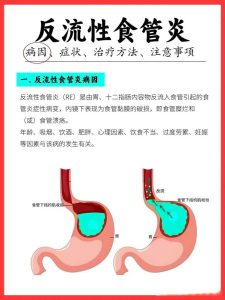 性欲低和胃食管反流有关吗？-两性知识丨两性健康--你想了解的我都知道