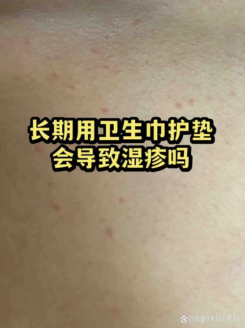 护垫长期使用会闷出炎症吗