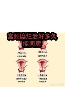 宫颈病变治疗后要禁同房多久？-两性知识丨两性健康--你想了解的我都知道