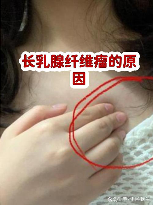 性欲低和乳腺纤维瘤有关吗-相关配图
