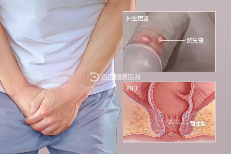 生殖器疣会癌变吗-相关配图