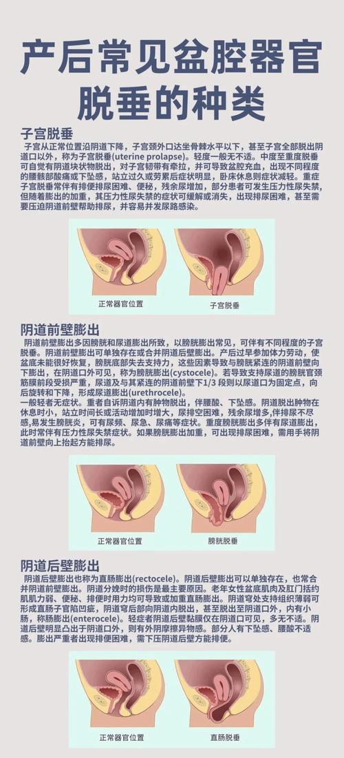 阴道前后壁膨出怎么发现
