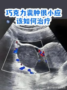 巧克力囊肿多大才需要动手术？-两性知识丨两性健康--你想了解的我都知道