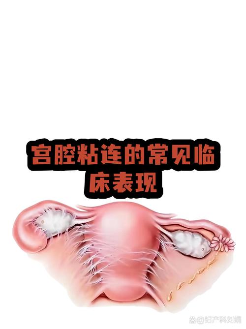 反复清宫会导致宫腔粘连吗