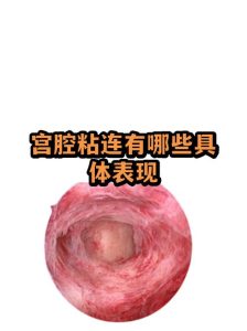 反复清宫会不会把子宫“粘住”啊?-两性知识丨两性健康--你想了解的我都知道