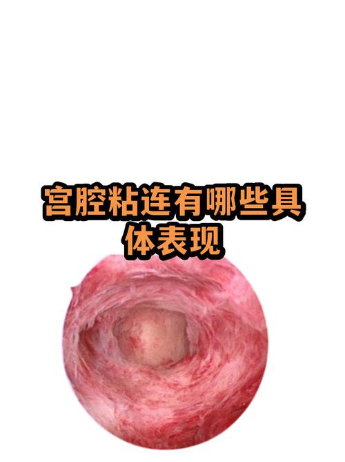 反复清宫会导致宫腔粘连吗