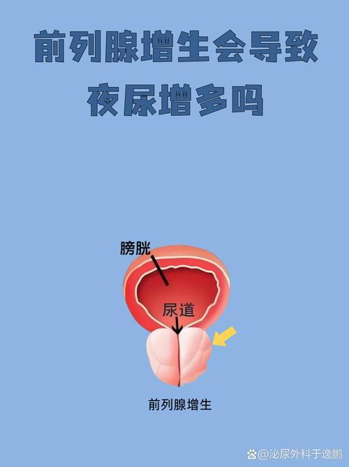 憋尿会加重前列腺增生吗
