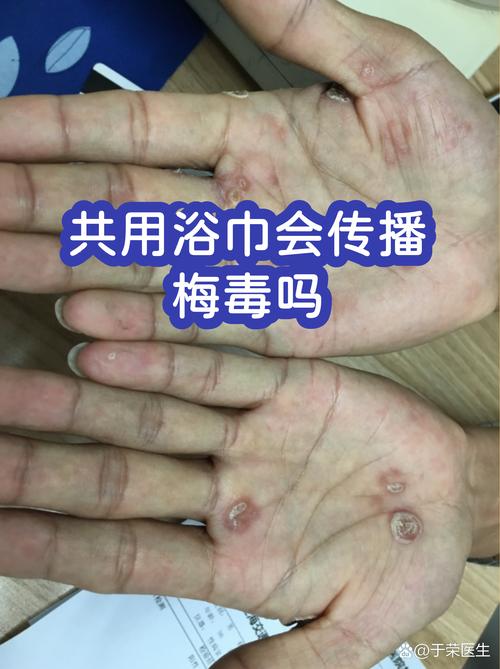 公共浴巾毛巾要担心性病吗-相关配图