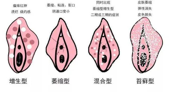 性欲低和外阴白斑有关吗-示意图