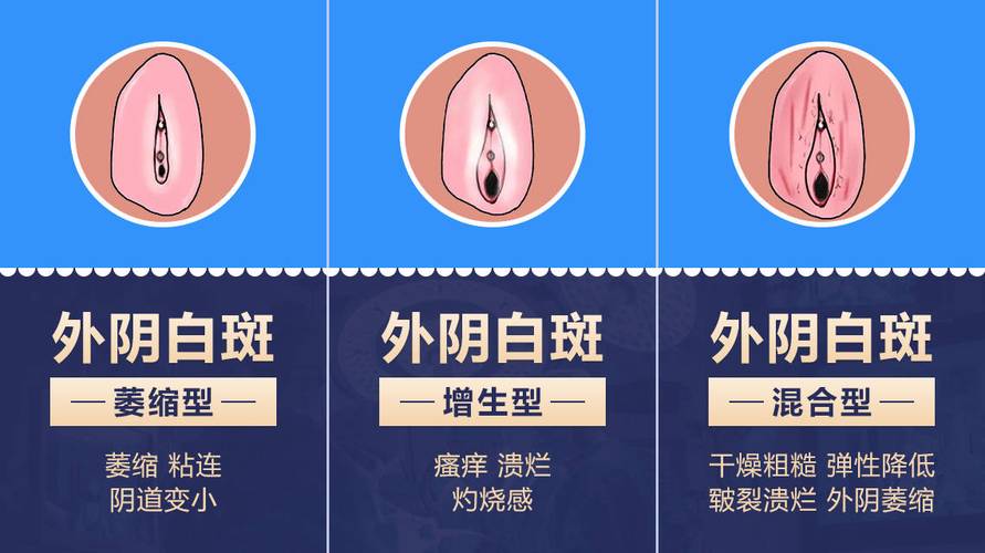 性欲低和外阴白斑有关吗-相关配图